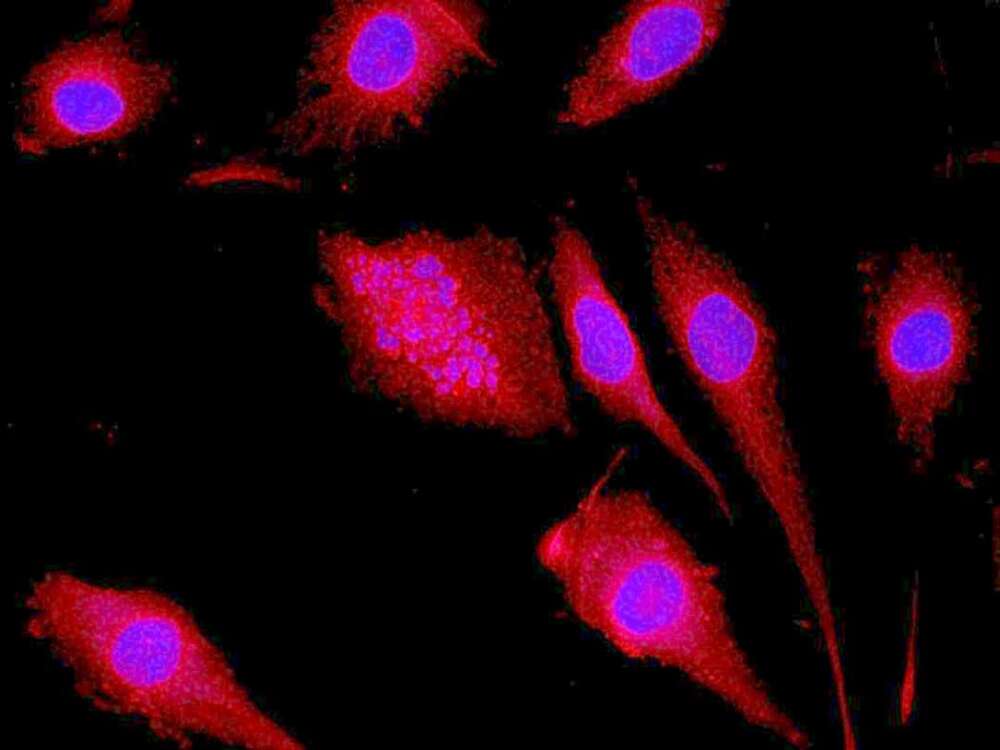 Células de glioblastoma humano in vitro. La proteína humanina (en rojo y los núcleos en azul) inhibe el efecto terapéutico de la quimioterapia.